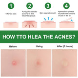 24pcs Acne Pimple Patch with Tea Tree Oil, Calendula Oil & Belgium Hydrocolloid