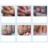 10ml Chinese Medicine Herbs Toe Nail Fungus Treatment Massage Anti Fungal Nail Infection  Nail Care Massage patch D132